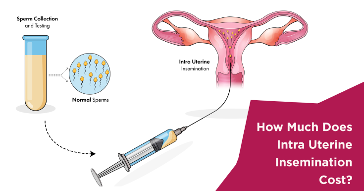  How Much Does Intrauterine Insemination (IUI) Treatment Cost?