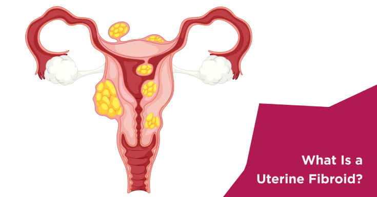 Uterine Fibroid