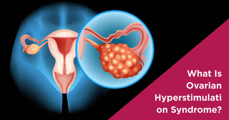 Ovarian Hyperstimulation Syndrome(OHSS)