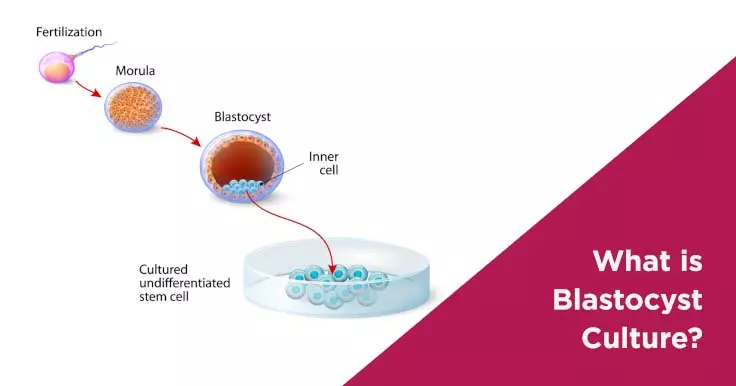  Blastocyst Culture in IVF: Understand its Stages and Benefits