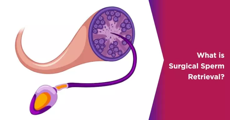  Surgical Sperm Retrieval: Procedure Explained