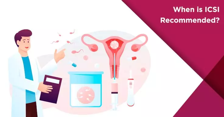  When Is ICSI Recommended? A Guide to Intracytoplasmic Sperm Injection