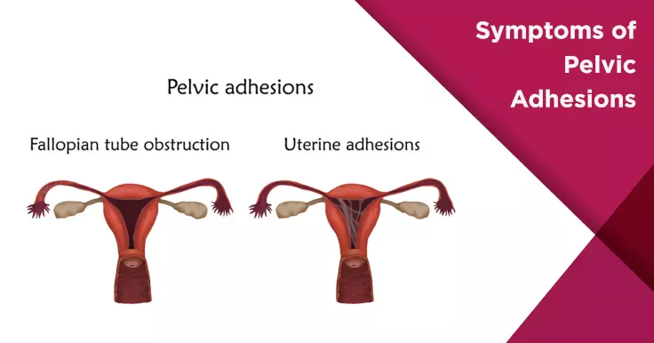  Symptoms of Pelvic Adhesions: How They Affect Fertility and Treatment
