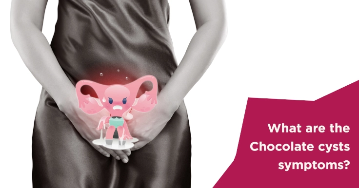  Chocolate Cysts Symptoms Explained