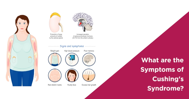  Cushing's Syndrome Symptoms: How It Affects Your Health and Fertility