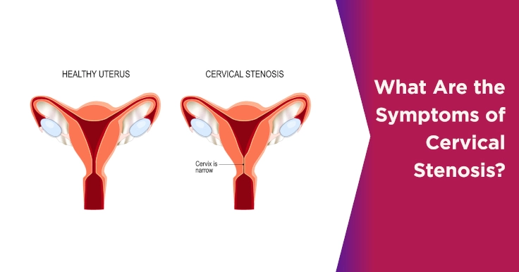  Cervical Stenosis Symptoms: What It Means for Your Reproductive Health