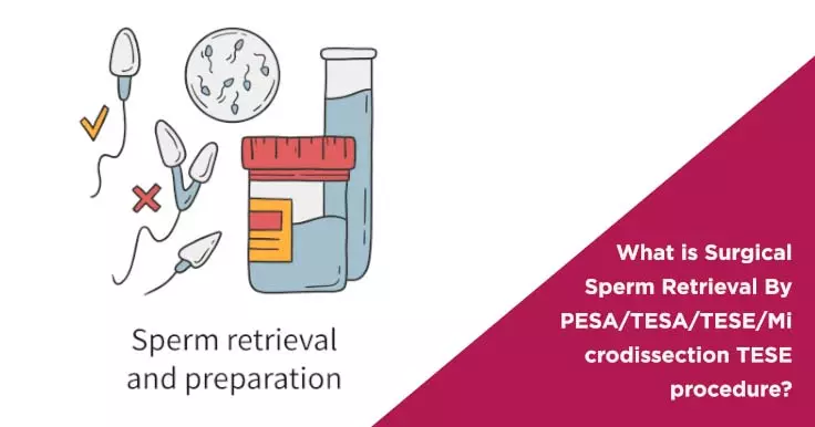  Surgical Sperm Retrieval Techniques: Options and Procedures Explained