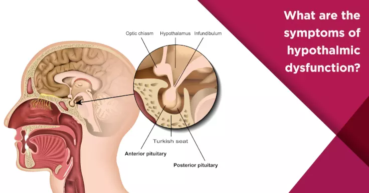  Hypothalamic Dysfunction Symptoms: Impact on Reproductive Health