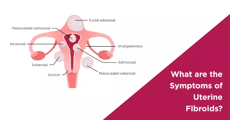  Uterine Fibroids Symptoms: How They Affect Fertility and Health
