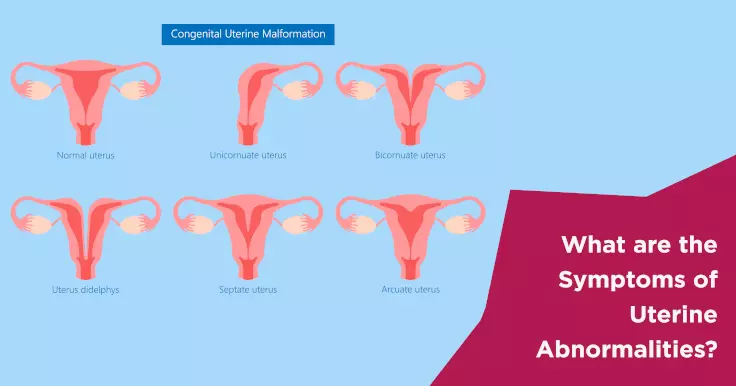  Uterine Abnormalities Symptoms: Diagnosis and Fertility Impact
