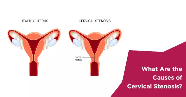  Causes of Cervical Stenosis: What You Need to Know