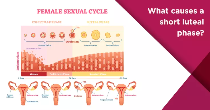  Causes of Short Luteal Phase: Impacts on Fertility