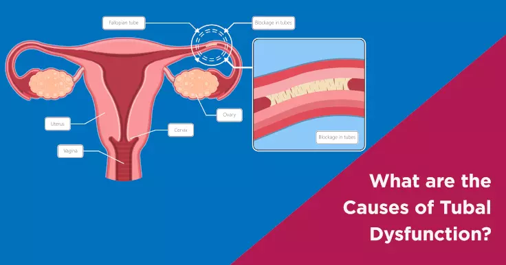  Understanding the Causes of Tubal Dysfunction