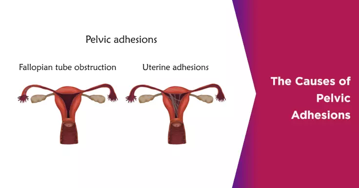  Causes of Pelvic Adhesions: Impact on Reproductive Health