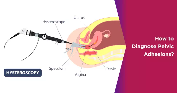  How to Diagnose Pelvic Adhesions: A Guide