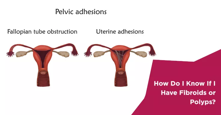  Identifying Fibroids or Polyps: What You Should Know