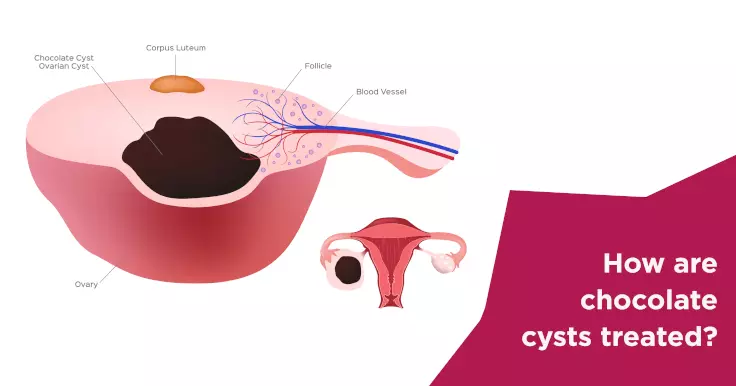  Chocolate Cyst Treatment: Options and Insights