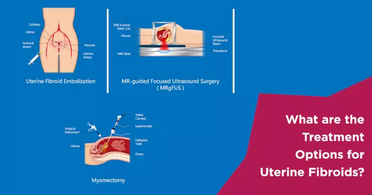  Treatment for Uterine Fibroids: An Overview