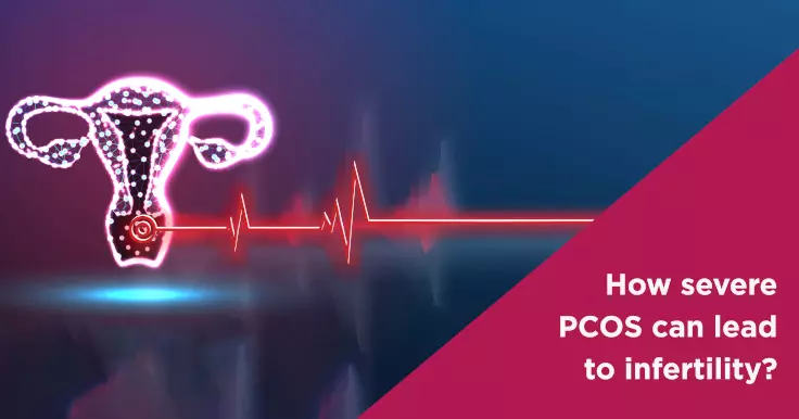  Does PCOS Lead To Infertility?