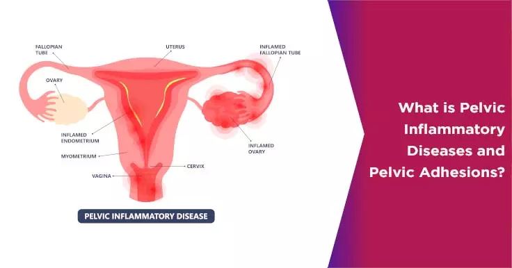  Pelvic Inflammatory Disease and Pelvic Adhesions: A Comprehensive Guide