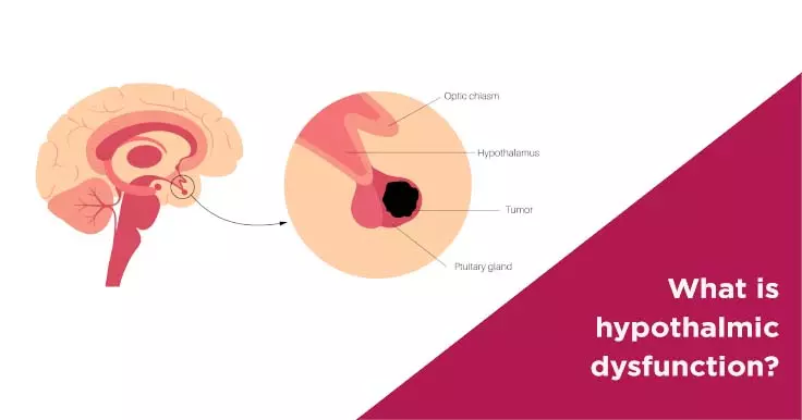Hypothalamic Dysfunction