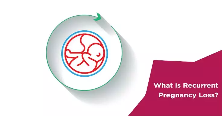  Understanding Recurrent Pregnancy Loss: Causes and Solutions