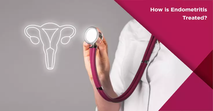  Treatment for Endometritis: How to Manage Uterine Inflammation