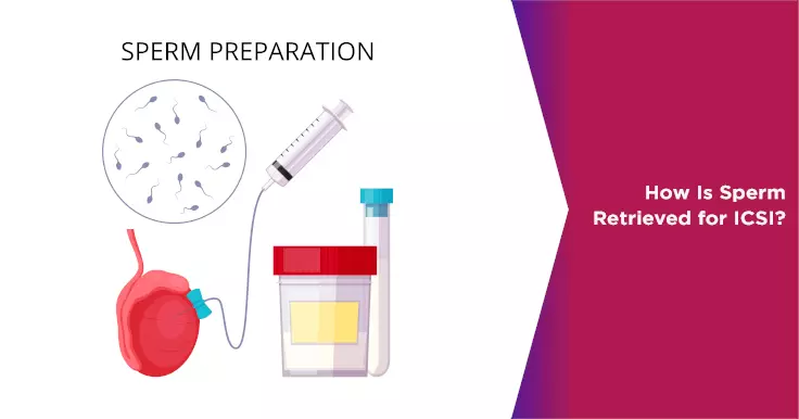  ICSI Sperm Retrieval Techniques: Methods to Enhance Fertility Treatment