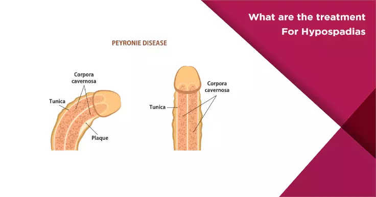  Hypospadias Treatment Options: How to Correct This Condition