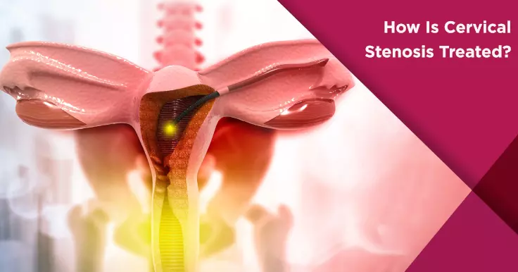  Cervical Stenosis Treatment: Methods and Expectations