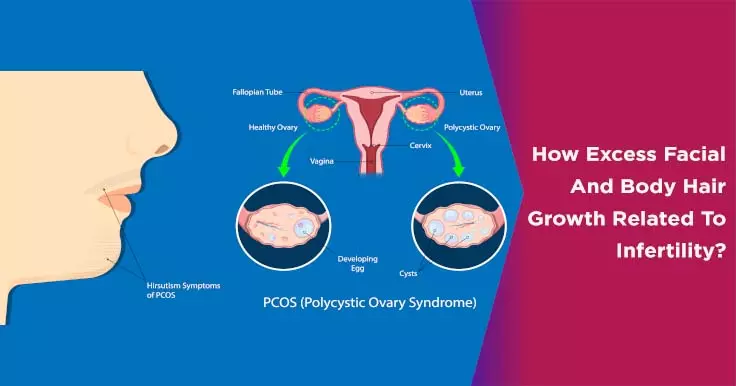  Hirsutism in Women: Causes and Effective Treatment Options