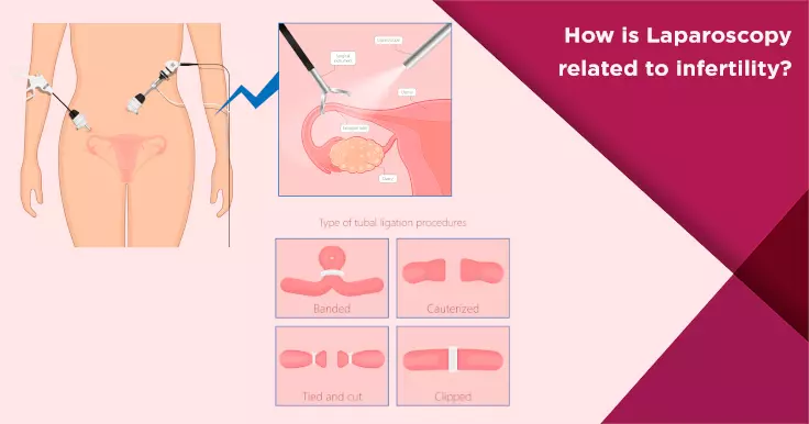  Laparoscopy and Infertility Treatment: Is It Related?