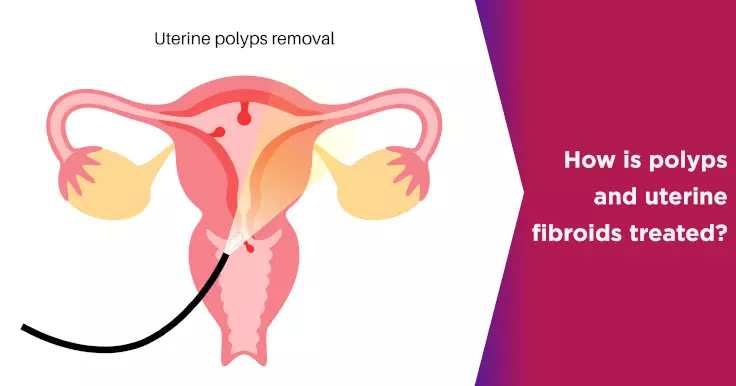  Uterine Polyps Treatment: What You Should Know
