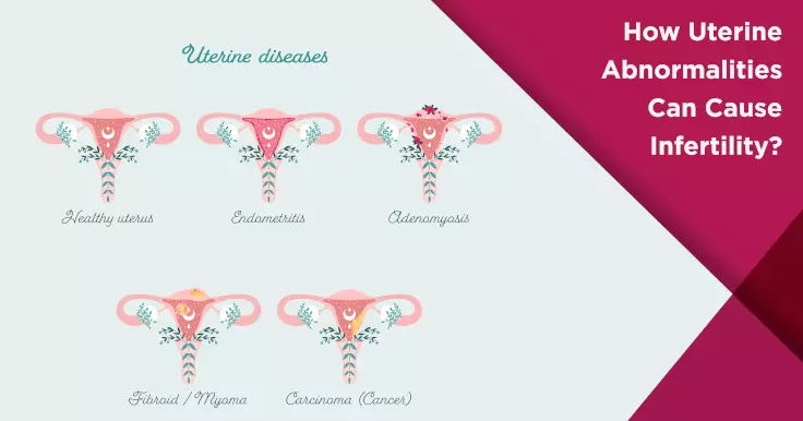  How Uterine Abnormalities Can Lead to Infertility