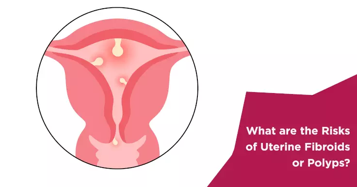  Risk Factors for Uterine Fibroids and Polyps: Essential Information