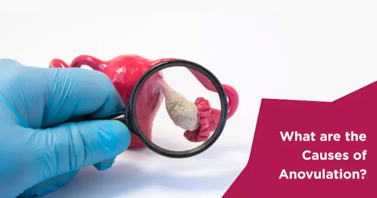  Anovulation Causes: Understanding the Reasons Behind Irregular Cycles