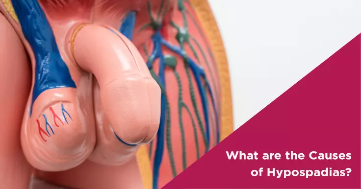  Hypospadias Causes and Its Effect on Male Reproductive Health