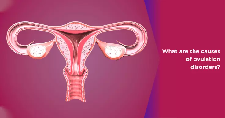  What Are the Causes of Ovulation Disorders?