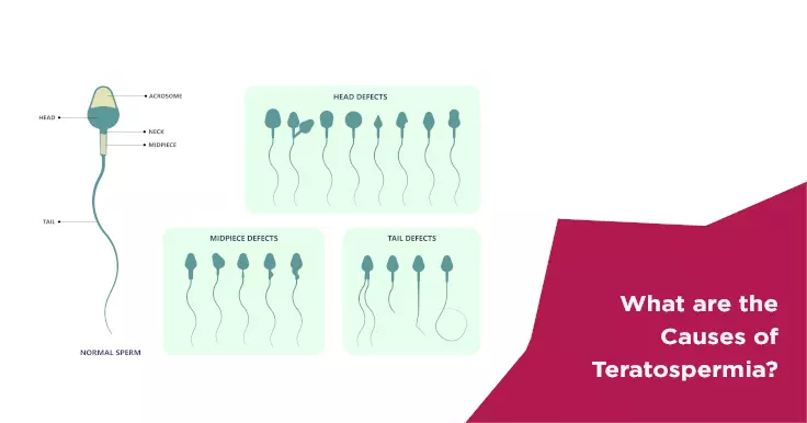 Causes of Teratospermia: Understanding Abnormal Sperm Shape