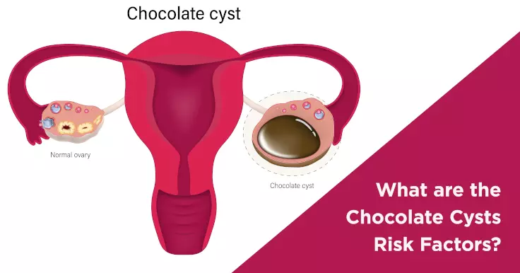  Risk Factors for Chocolate Cysts: A Comprehensive Overview