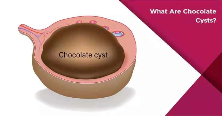 Chocolate Cysts