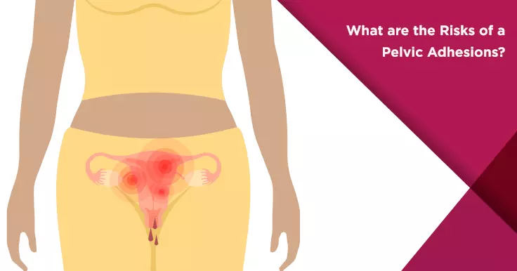  Risks Associated with Pelvic Adhesions: What You Need to Know