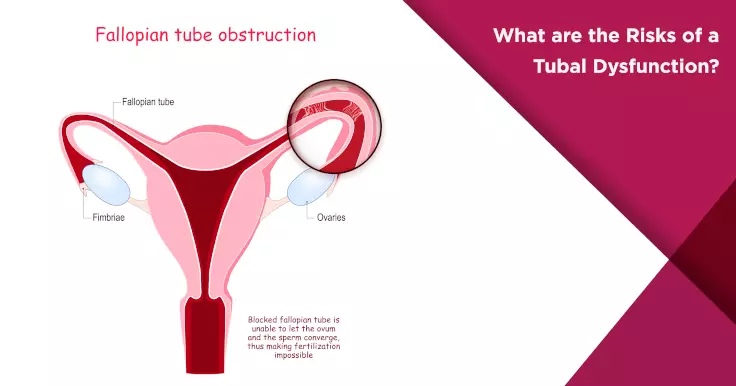  Risks of Tubal Dysfunction: What You Should Be Aware Of