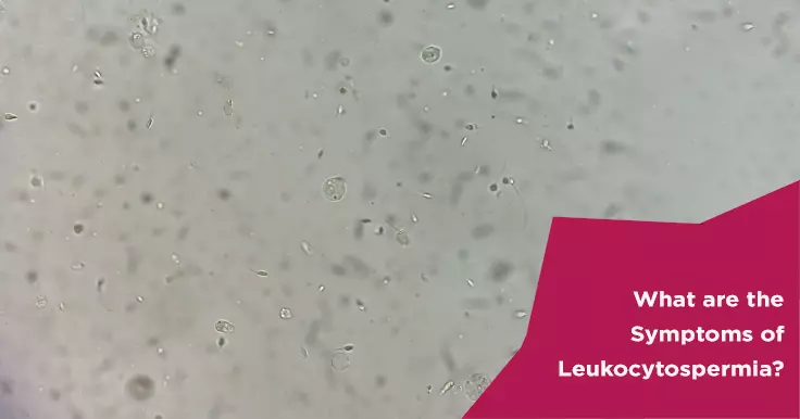  Leukocytospermia Symptoms: Impact on Sperm Health