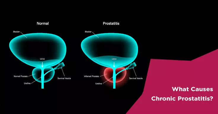  Chronic Prostatitis Causes: How It Impacts Male Reproductive Health