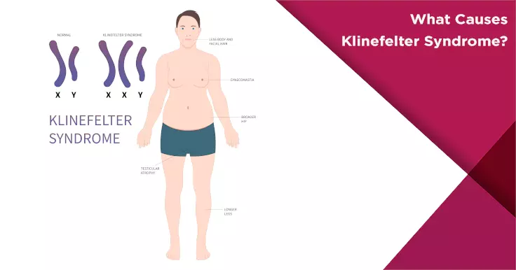  Causes of Klinefelter Syndrome: Genetic Factors and Effects