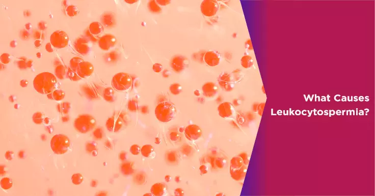  Causes of Leukocytospermia: Understanding the Condition