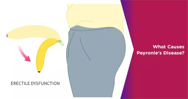  Causes of Peyronie's Disease: What Leads to Penile Curvature?