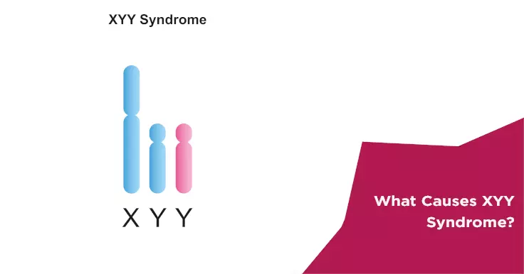  Causes of XYY Syndrome: Understanding the Genetic Condition