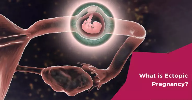  What Is an Ectopic Pregnancy? 